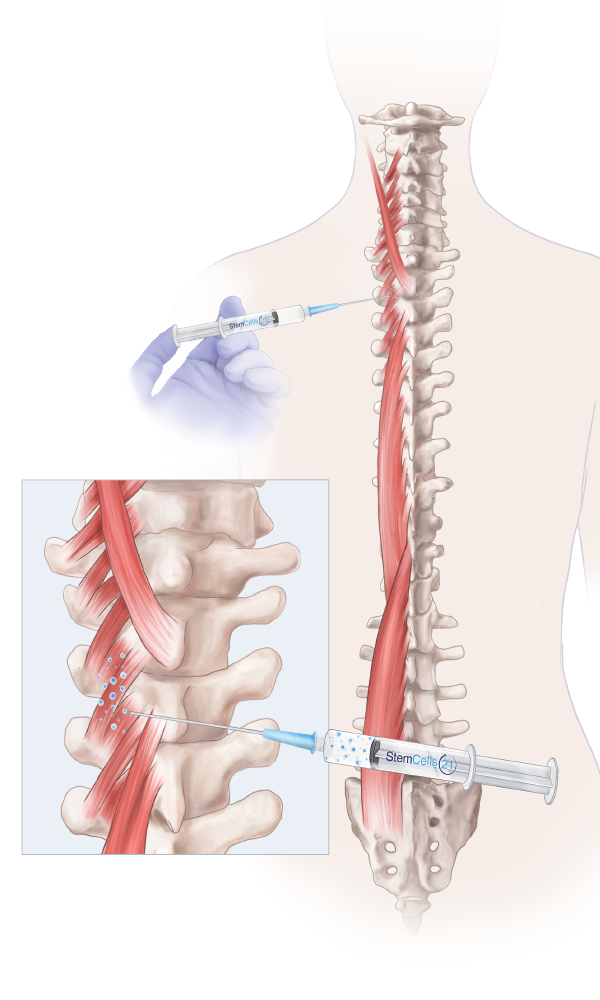 degenerative spine, degenerative spine treatment, chronic back pain treatment, stem cell back injection, stem cell treatment for spine, stem cell therapy for spine, back stem cell treatment, stemcells21,